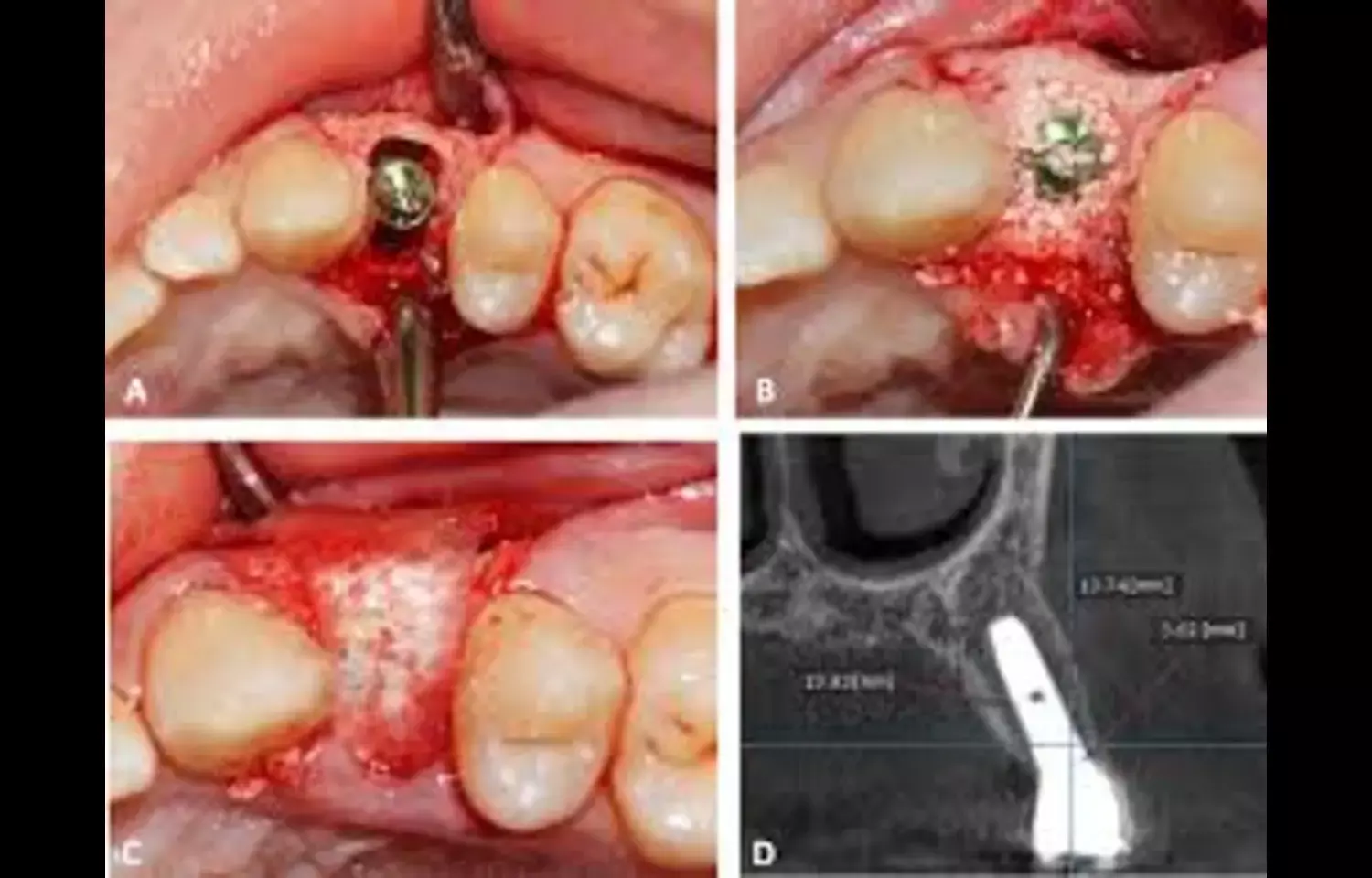 Platelet-rich fibrin enhances Hard and Soft Tissue Regeneration in Immediate Implant Placement: Study