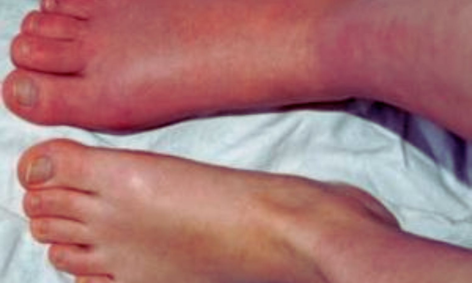 Bisphosphonates Linked to Short-Term Pain Reduction in Complex Regional Pain Syndrome: Study