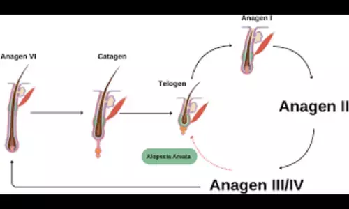 Blood Metabolites May Have Causal Links with Alopecia Areata: Study Blood Metabolites May Have Causal Links with Alopecia Areata: Study