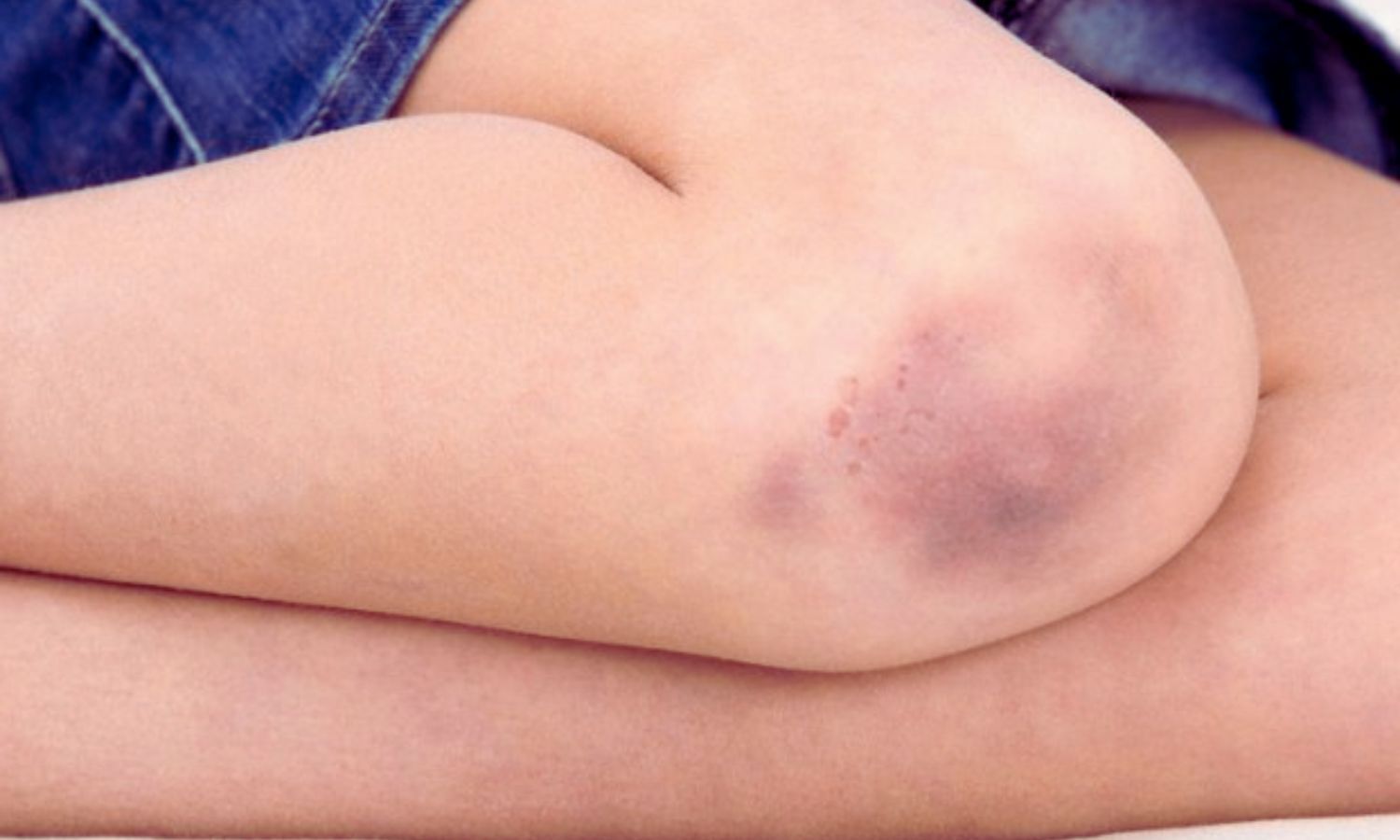 Common TB Drug, Rare Blood Reaction: Case Report Links Ethambutol to Platelet Drop