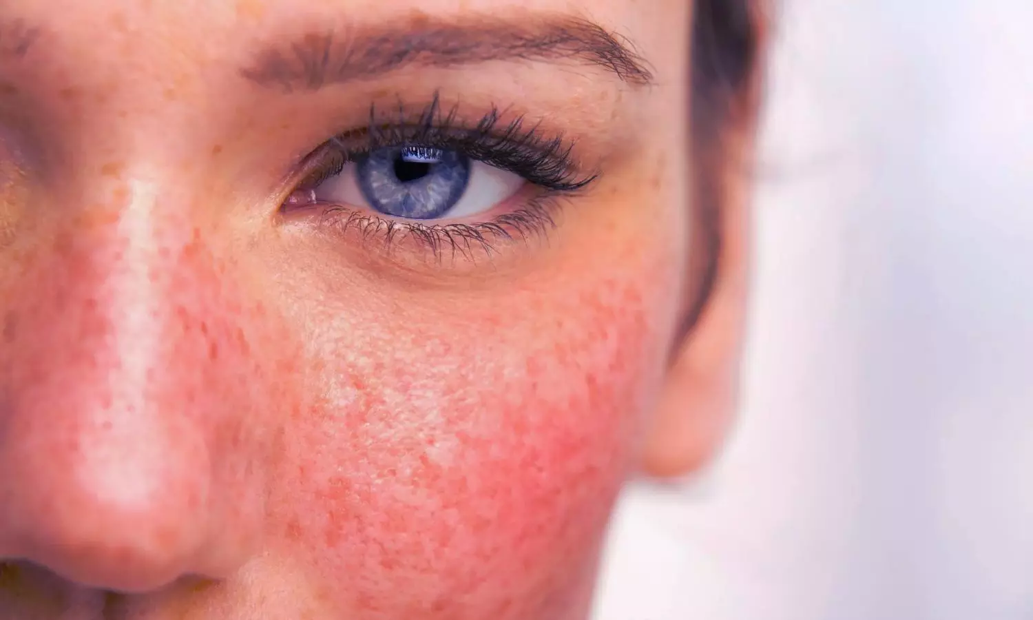 Paroxetine May Modulate Neurovascular-Immune Pathways in Rosacea: Study Paroxetine May Modulate Neurovascular-Immune Pathways in Rosacea: Study