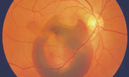 Rare Finding: Adenocarcinoma Discovered in 17-Year-Old with Peutz–Jeghers Syndrome, Case Report