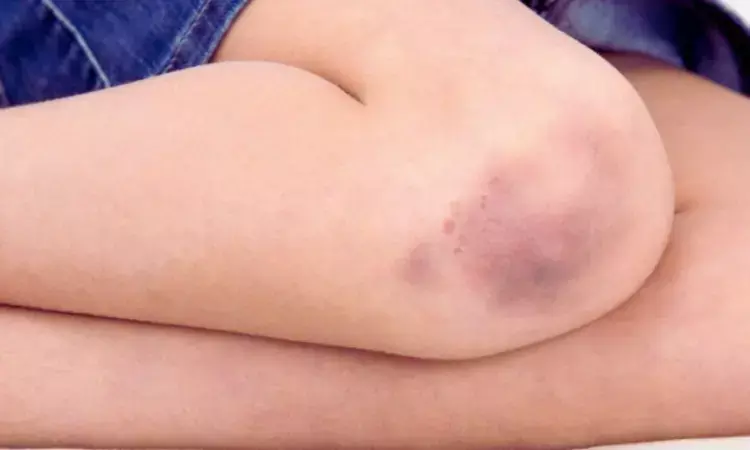 Common TB Drug, Rare Blood Reaction: Case Report Links Ethambutol to Platelet Drop Common TB Drug, Rare Blood Reaction: Case Report Links Ethambutol to Platelet Drop