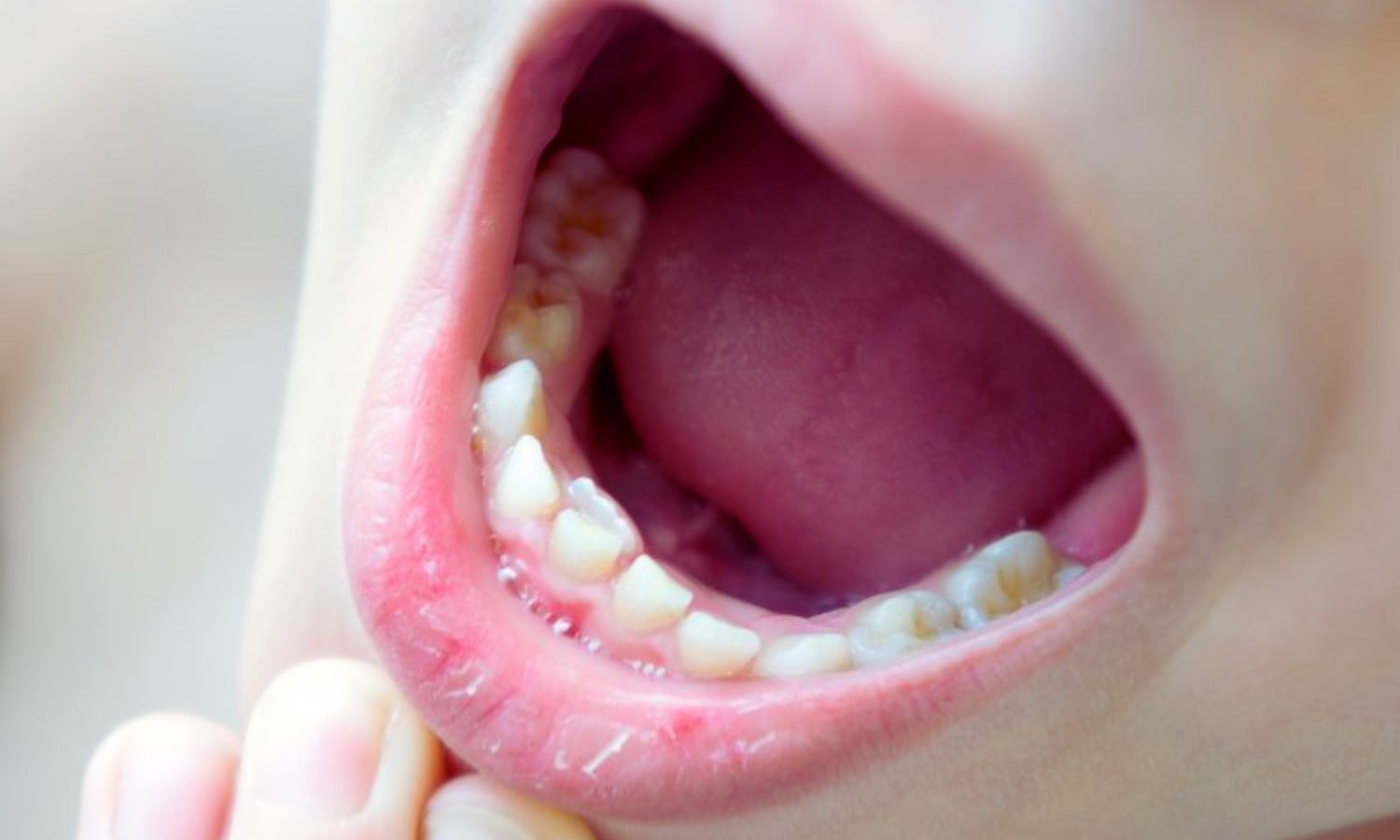 Resorbable and Non-Resorbable Membranes Both Effective for Guided Bone Regeneration for dental implant site development: Study