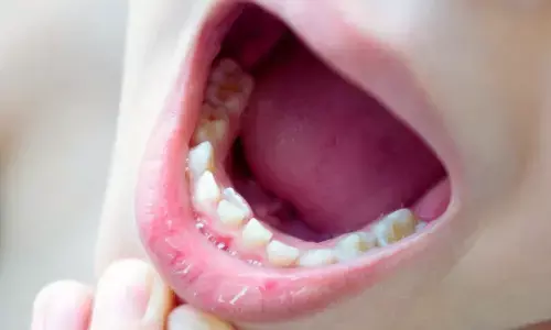 Aromatherapy with levander effective for Managing Dental Anxiety, suggests research