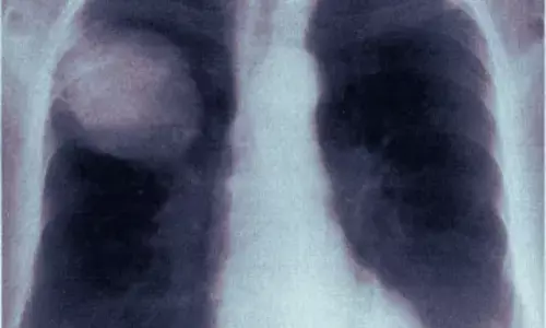 Study Reports First Successful Non-Surgical Treatment of Postoperative Lung Torsion