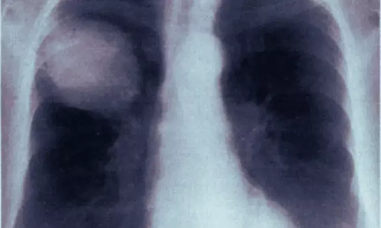 Study Reports First Successful Non-Surgical Treatment of Postoperative Lung Torsion