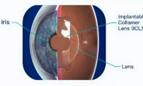 Vertical ICL Fixation Delivers Safer, More Predictable Vault Outcomes: Study Finds