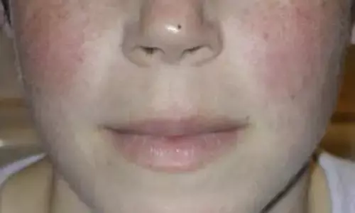 Telitacicept Matches Belimumab in Controlling Childhood Lupus, Study Finds