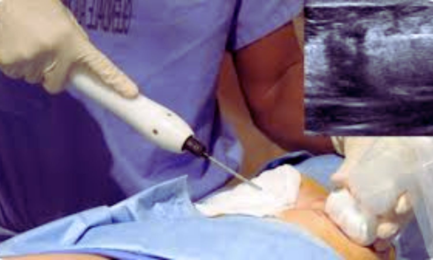 Early-Stage Breast Cancer: Cryoablation Delivers Effective Tumor Control With Faster Recovery, Study Finds