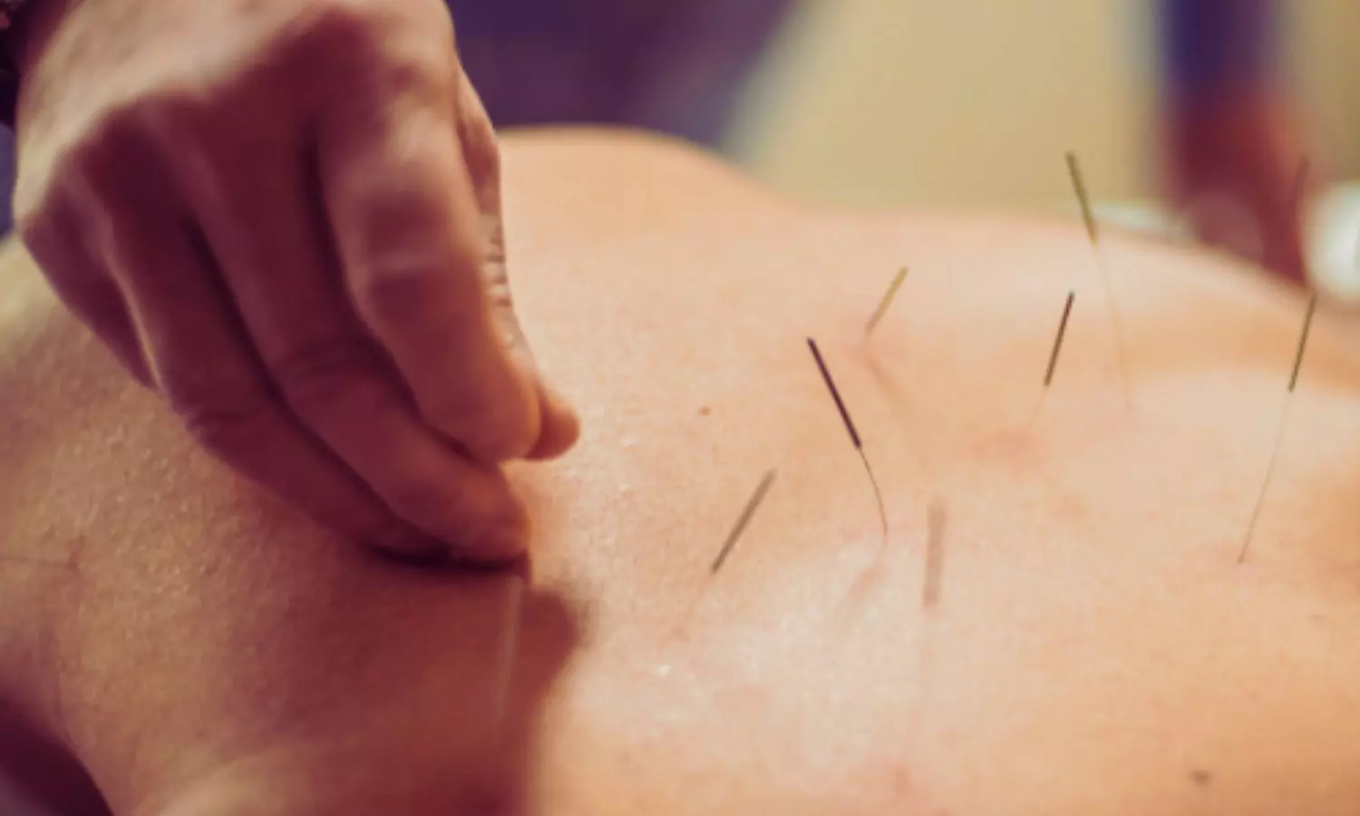 Governor Vessel Acupuncture Shows Neuroprotective Benefits in Experimental Ischemic Stroke: Meta-Analysis Governor Vessel Acupuncture Shows Neuroprotective Benefits in Experimental Ischemic Stroke: Meta-Analysis