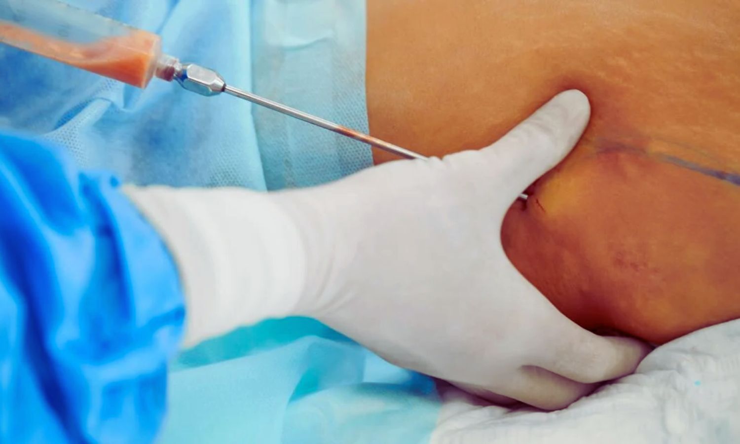 AI Model Accurately Predicts Blood Loss During Liposuction, Improves Safety: Study