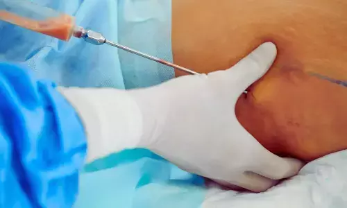 AI Model Accurately Predicts Blood Loss During Liposuction, Improves Safety: Study AI Model Accurately Predicts Blood Loss During Liposuction, Improves Safety: Study