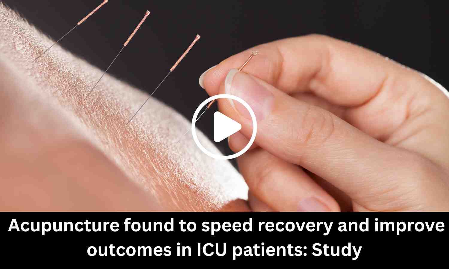 Acupuncture speeds recovery and improves outcomes in ICU patients: Study finds