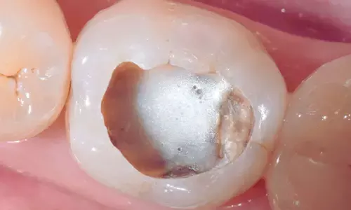 Protective Liner Type Does Not Affect Clinical Outcomes After Performing Selective Caries Removal: Indian Study Reveals