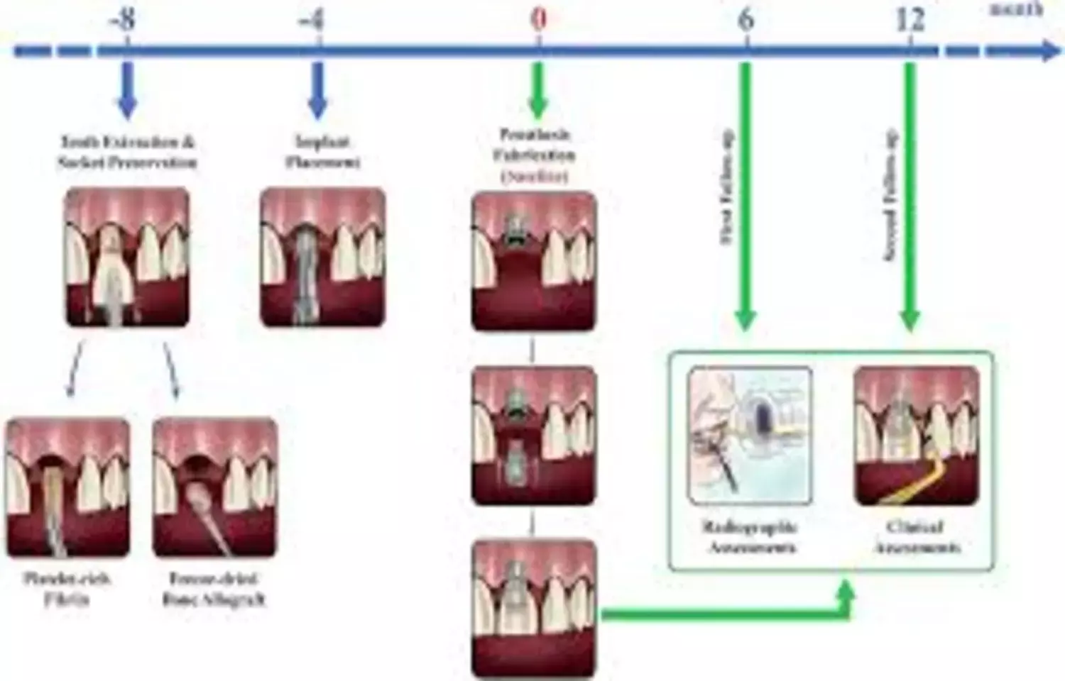 Extended platelet-rich fibrin Membranes Effective and Natural Alternative for Ridge Preservation: Study