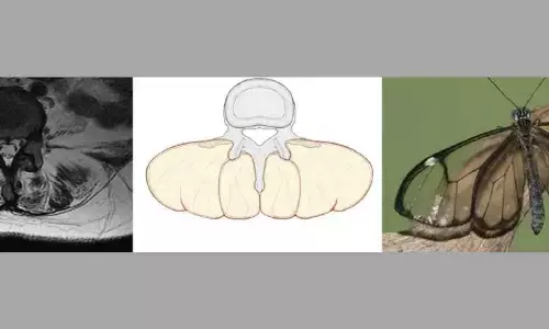 The greta oto sign for diagnosing axial myopathy with low back pain: a novel MRI sign: Study