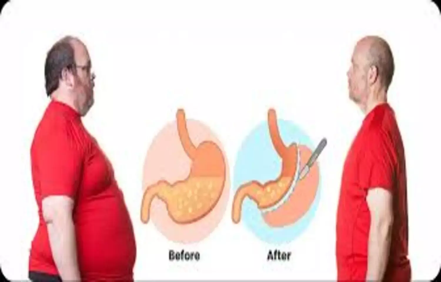 Bariatric Surgery Linked to Lower Risk of Adverse Kidney Outcomes: Study