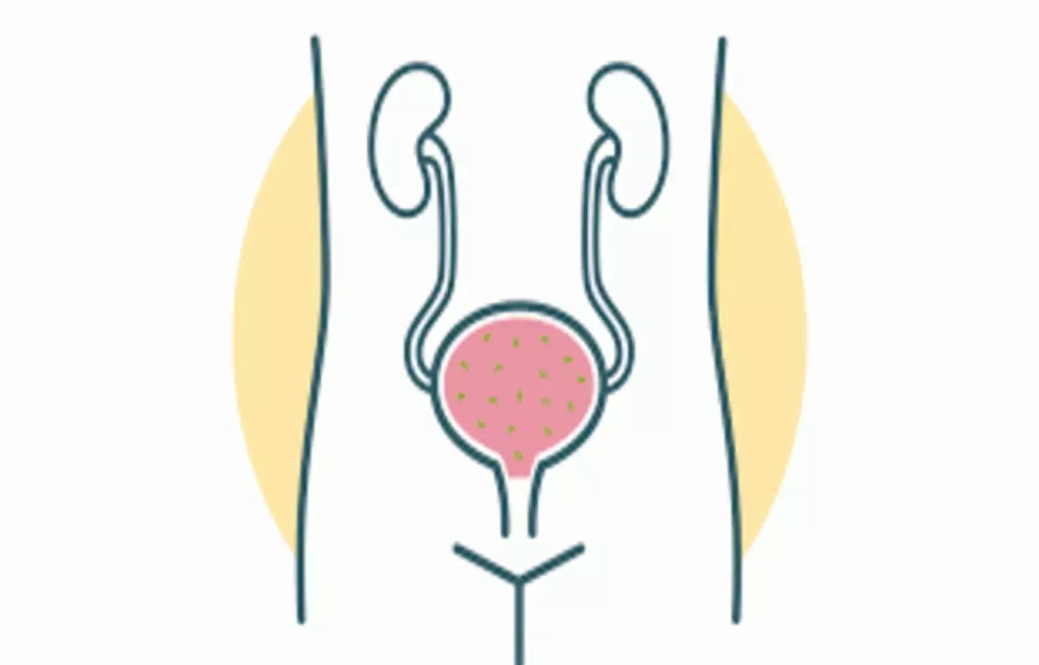 Intravesical Gentamicin fails to Reduce Post-Transplant UTI Risk: Study Intravesical Gentamicin fails to Reduce Post-Transplant UTI Risk: Study