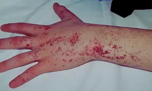 Lucerastat Shows Exploratory Renal Signals in Fabry Disease: Study