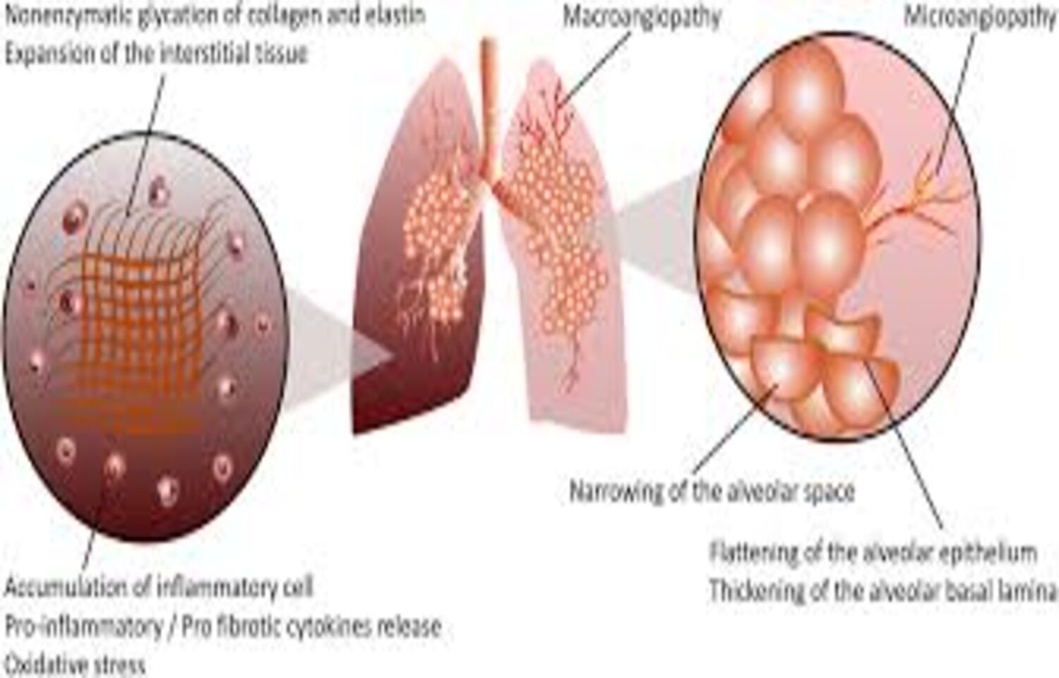 Hyperglycemia Associated with Lung Dysfunction in Asthma patients, reports research