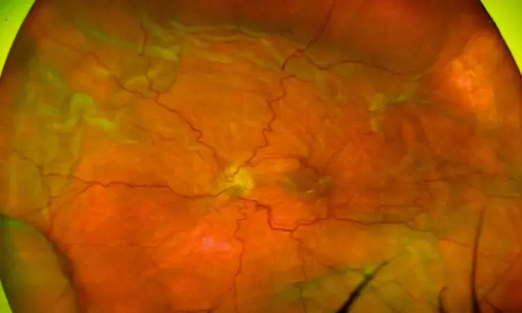 Intraocular HPMC Injections: Novel Treatment for Ocular Hypotony, Suggests Study Intraocular HPMC Injections: Novel Treatment for Ocular Hypotony, Suggests Study