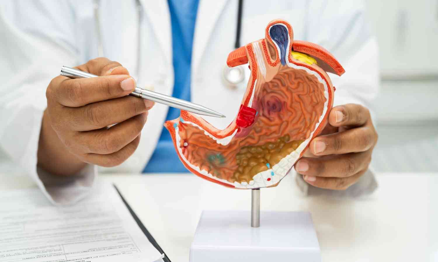 Long term use of anti-acid drugs may not increase stomach cancer risk