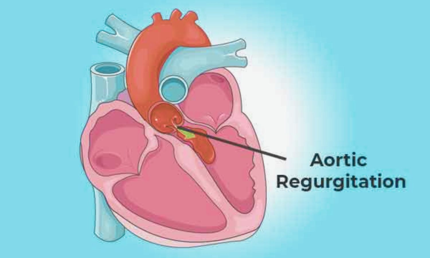 FDA Approves Trilogy TAVR System for Severe Aortic Regurgitation: Study