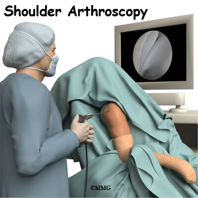 Arthroscopic Spinoglenoid Cyst Decompression and Labral Repair give excellent functional outcomes: study