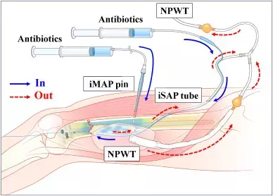 Continuous Local Antibiotic Perfusion: A Novel Technique for the Treatment of Orthopaedic Infections