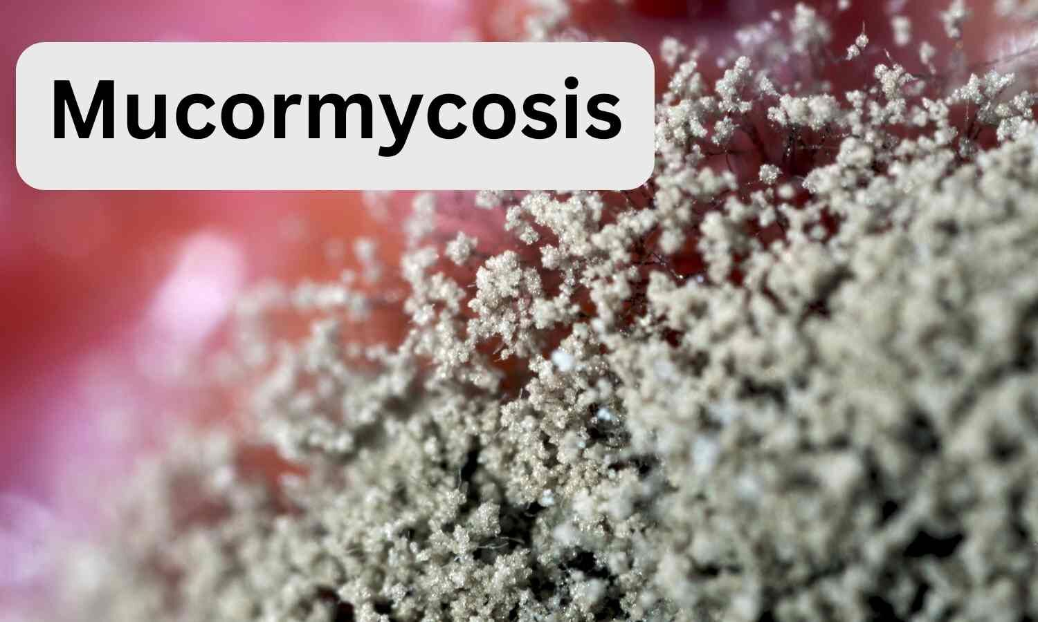 Study identifies blood protein albumin as key defense against deadly fungal infection “mucormycosis”