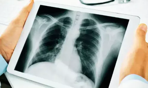 AI Matches Radiologists in Detecting TB From Photographed Chest X-Rays: Study Shows