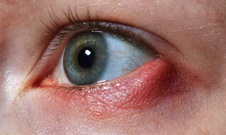 Large-scale genetic study sheds light on the background of allergic conjunctivitis Large-scale genetic study sheds light on the background of allergic conjunctivitis