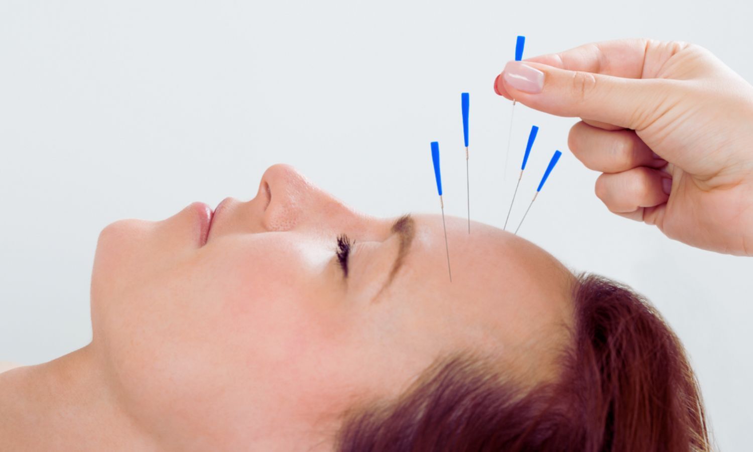 Acupuncture Provides Significant Pain Relief and Functional Improvement in Migraine Without Aura: JAMA