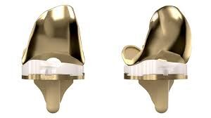 Kinematic Alignment-TKA using Medial Pivot implants appropriate surgical approach for valgus alignment knees: study