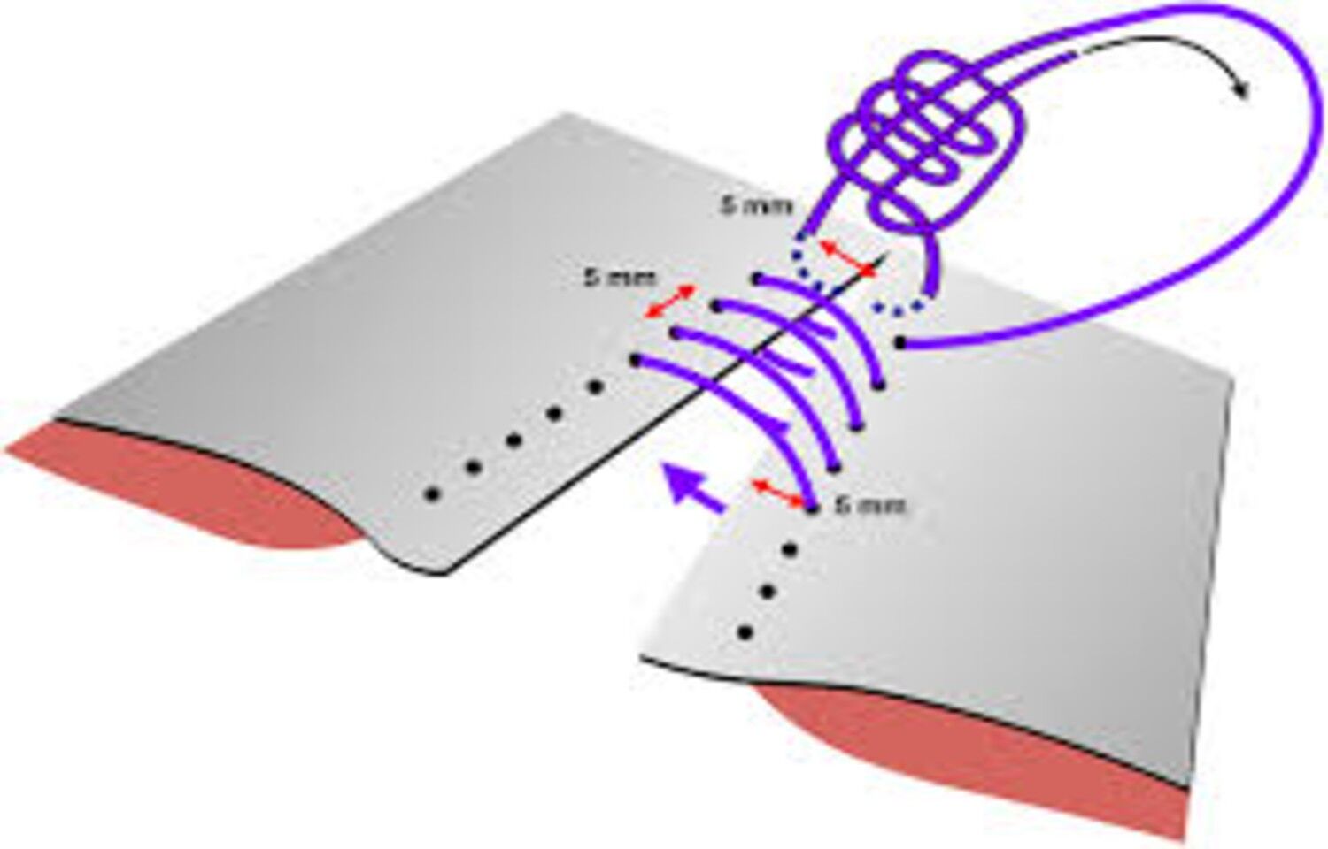Small-bite closure technique tied to reduced wound complications and  incisional hernia incidence in abdominal surgery: Study