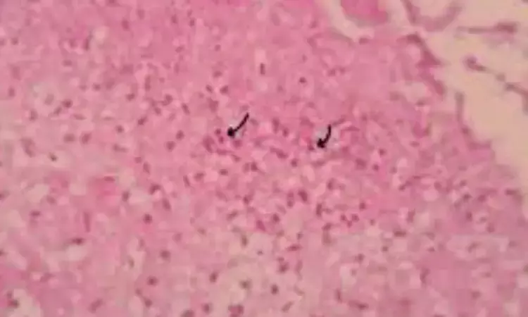 Pyoderma Gangrenosum Can Mimic Other Ulcers, Without Associated Systemic Disease: Case Report