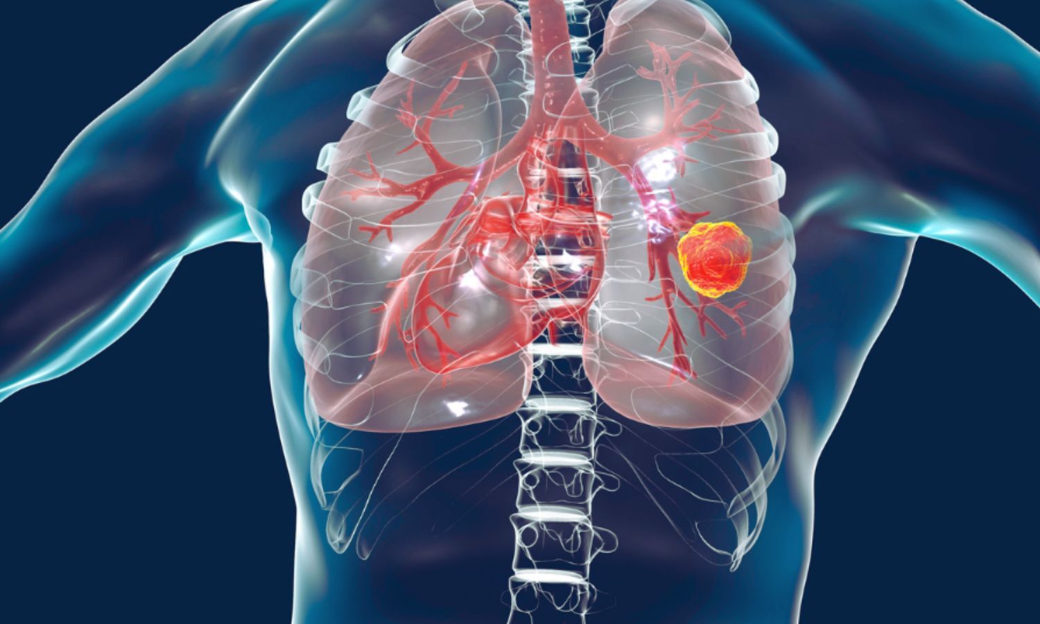 Setidegrasib Shows Promise for KRAS G12D-Mutated lung and pancreatic Cancers: NEJM