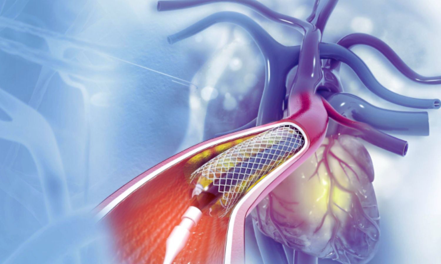 Epicardial Fat Linked to Coronary Disease Progression, Suggests Research