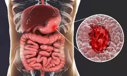 CRP and ACR Aid Risk Stratification in Perforated Peptic Ulcer Surgery: Study CRP and ACR Aid Risk Stratification in Perforated Peptic Ulcer Surgery: Study