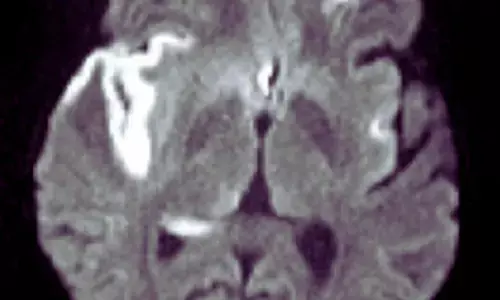 Dexamethasone Adds No Verbal Memory Benefit in Herpes Simplex Virus Encephalitis: The Lancet