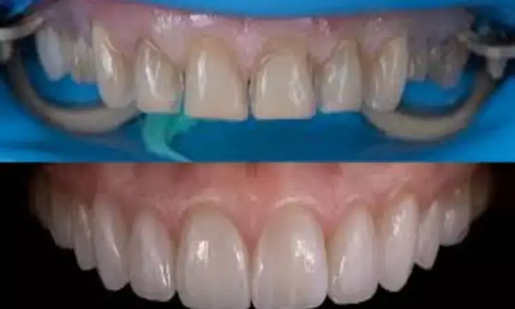 Zirconia Coping with Lithium Disilicate Veneers strong and ...