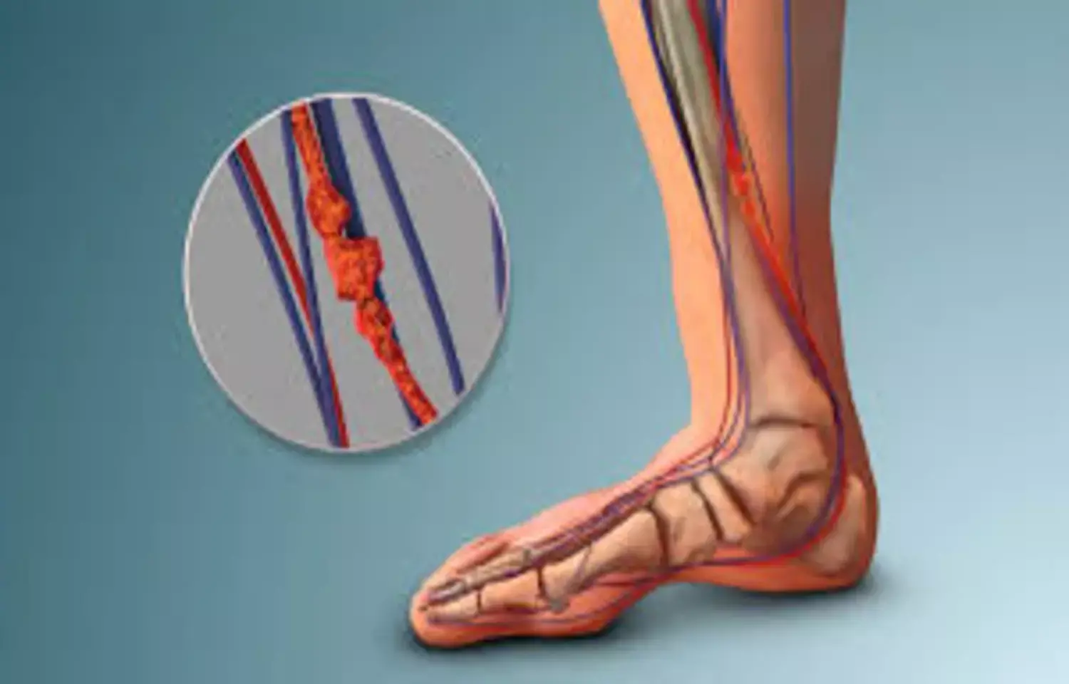 Age-Adjusted D-Dimer Cutoff may Safely Rule-Out DVT: JAMA