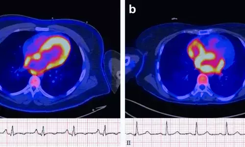 Atrial FDG Uptake on Cardiac PET Signals Higher Risk of Future Atrial Fibrillation: Study