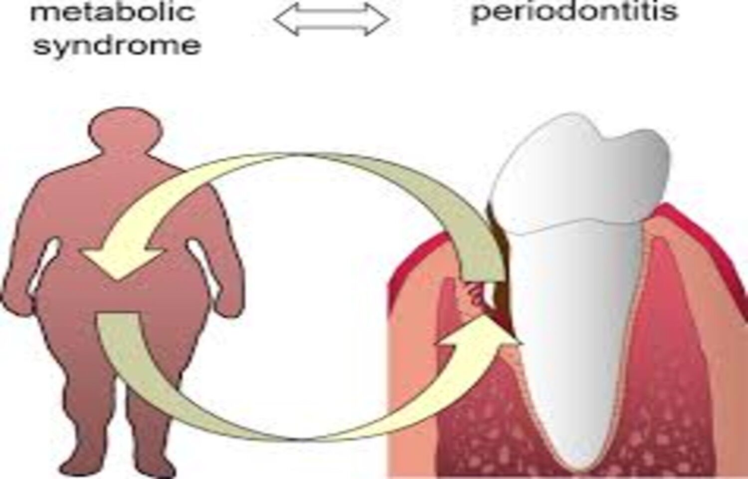 Metabolic Syndrome May Be Associated With Poor Oral Health: Study