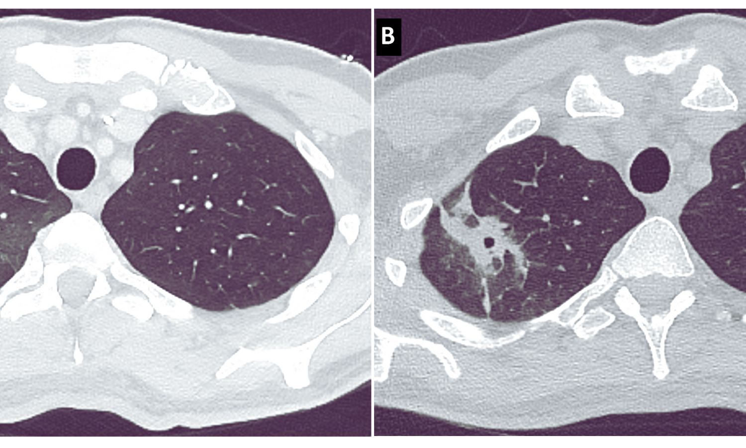 Liposomal Amphotericin B Has Comparable Outcomes With Triazoles in Invasive Aspergillosis, Finds Study