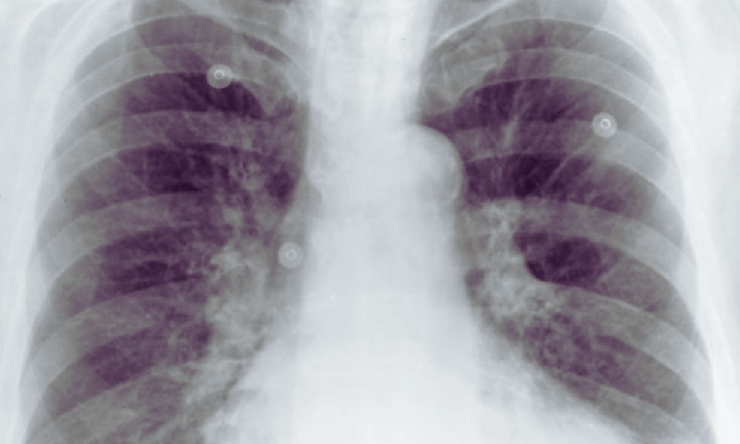 Aortic Calcification on Chest X-Ray Signals Poorer Survival After Minor Limb Amputation: Study