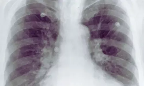 Aortic Calcification on Chest X-Ray Signals Poorer Survival After Minor Limb Amputation: Study