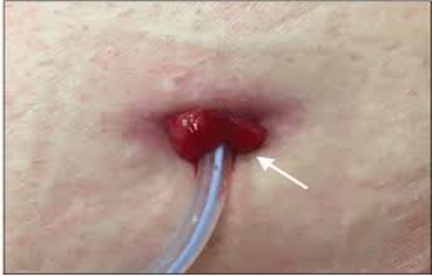 Common Salt Effective for PD Catheter Exit-Site Granulomas: Study