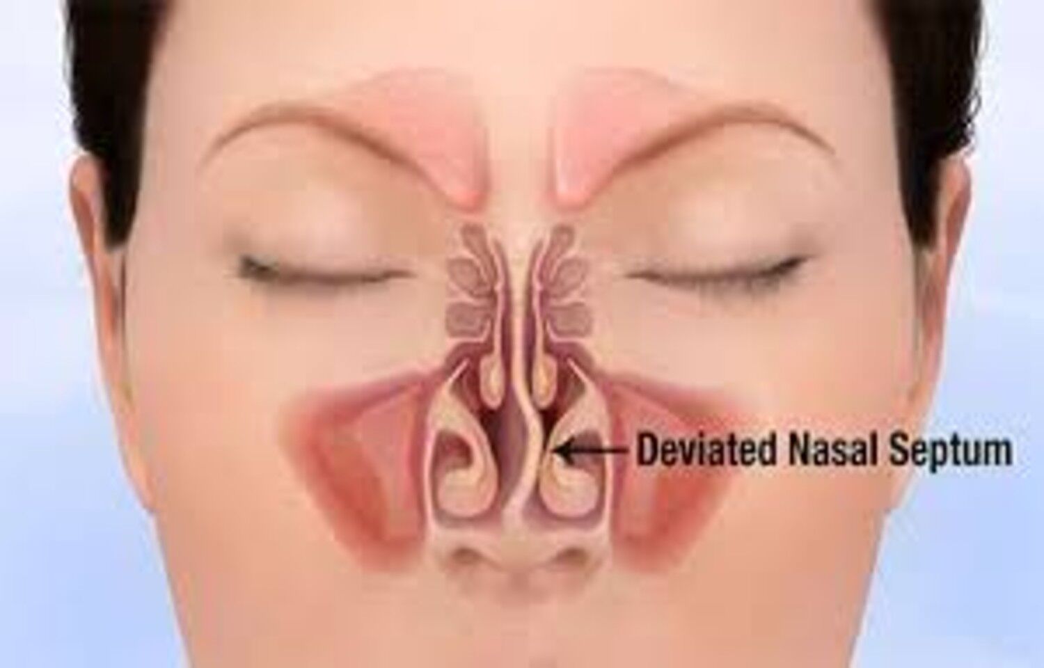 Nasal Deviation Associated With Temporomandibular Disorders, finds study